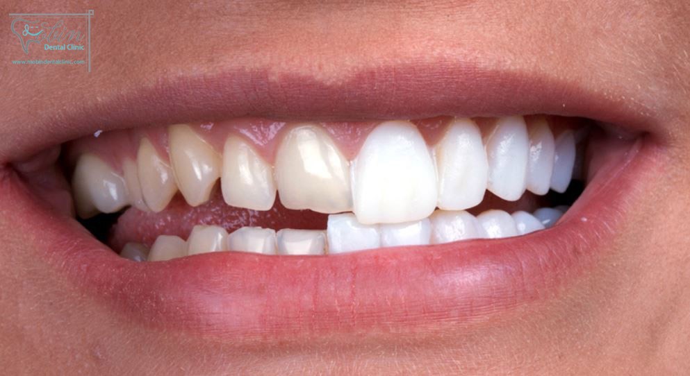 روکش دندان در مواردی که آسیب دندان شدید است کاربرد دارد